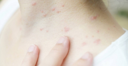Doenças da pele autoimunes e o potencial da aplicação de intervenções mais precoces