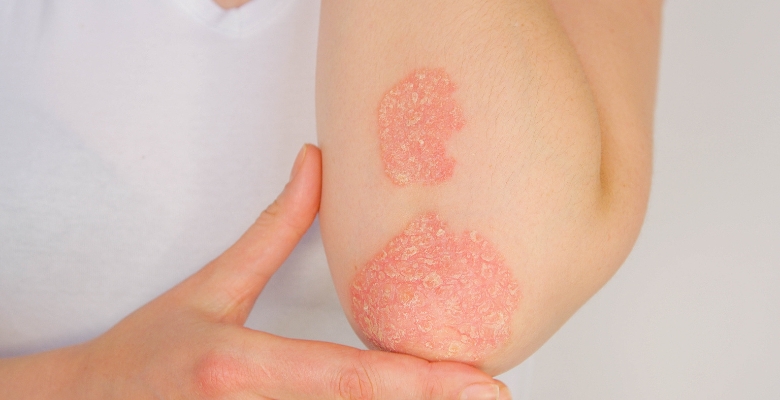 EULAR propõe novas definições para artrite psoriática de difícil controlo e refratária ao tratamento