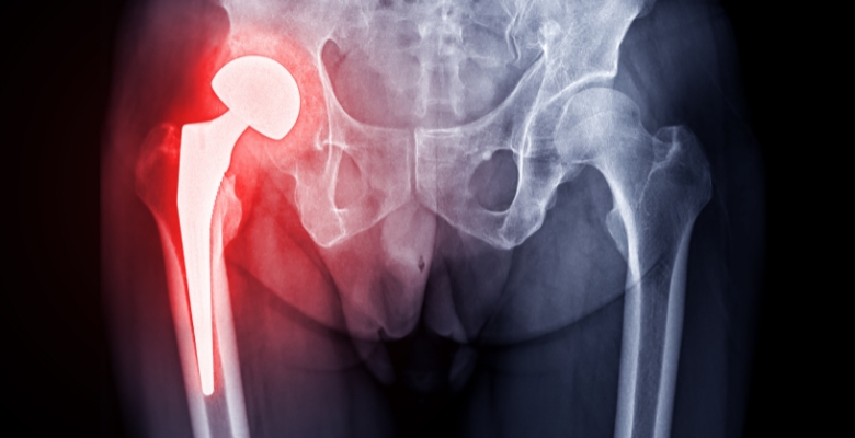Osteoartrite da anca: ácido hialurónico de alto peso molecular sem vantagem clínica face a outras terapias