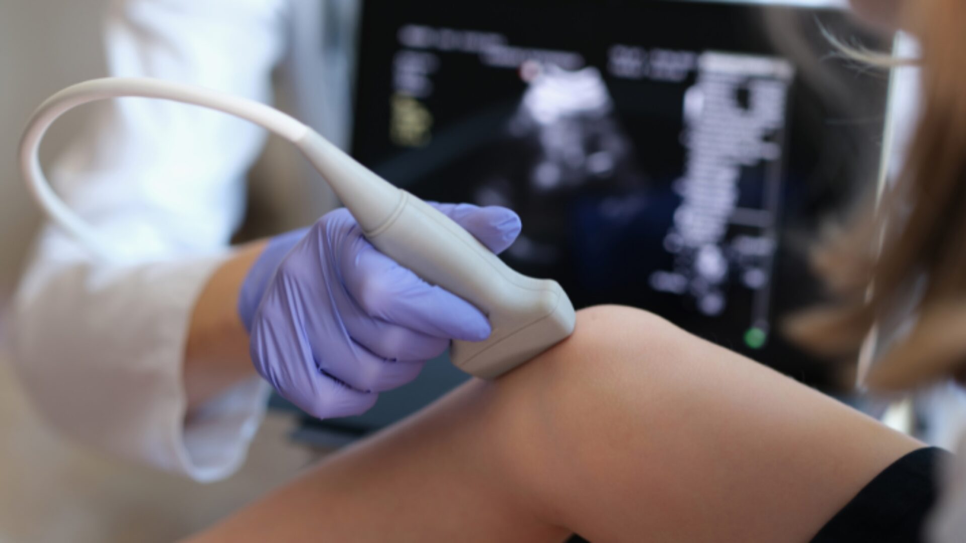 Técnica de ultrassom identifica dois fenótipos de artrite psoriática grave